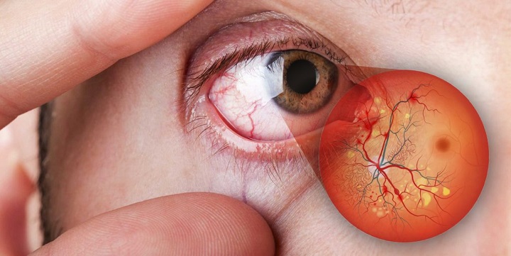 retinopatia diabetica prevenção